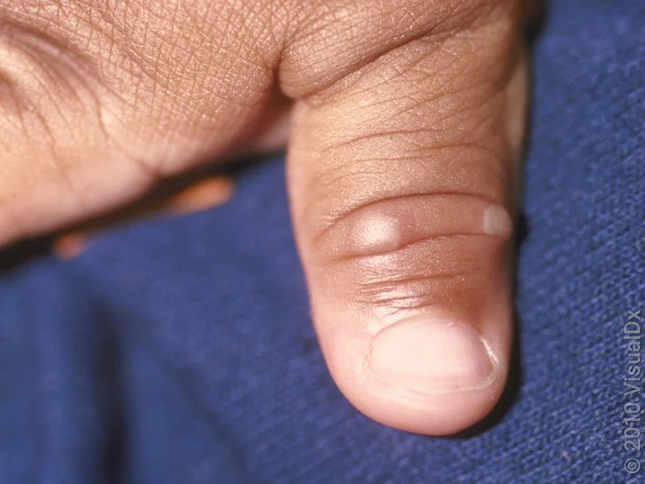 Blisters on the hand caused by hand, foot, and mouth disease.