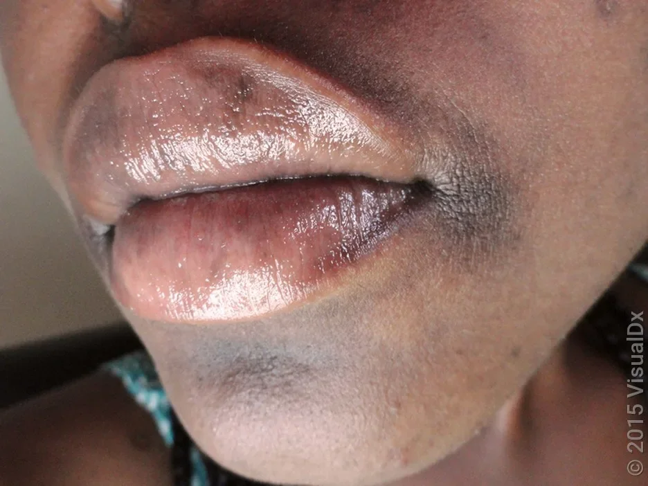 A rough, brown patch at the corner of the mouth in angular cheilitis.