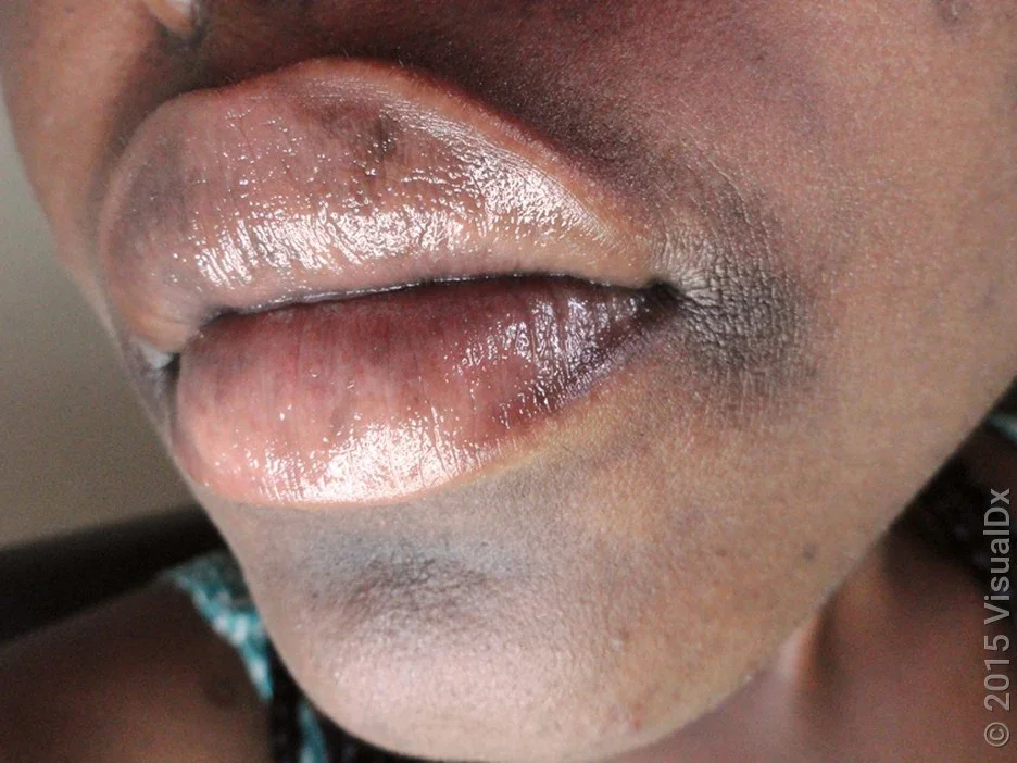 A rough, brown patch at the corner of the mouth in angular cheilitis. 
