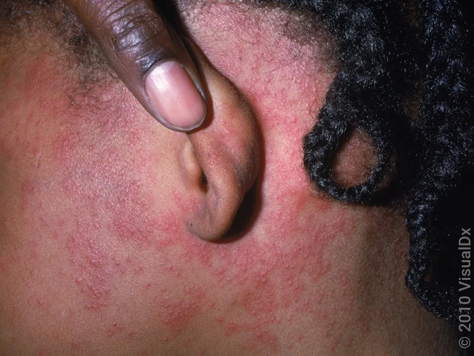 Close-up of the measles rash on the face and behind the ear.