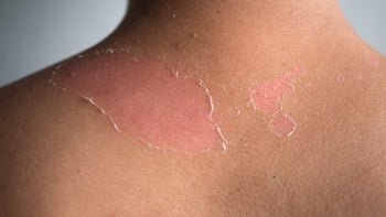Health: Dermatology: peeling rash and sunburn-868346006