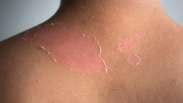 Health: Dermatology: peeling rash and sunburn-868346006