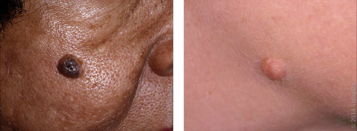 Left: A large, round, brown skin bump on the cheek. Right: A pink smooth bump that sticks out on the cheek. 