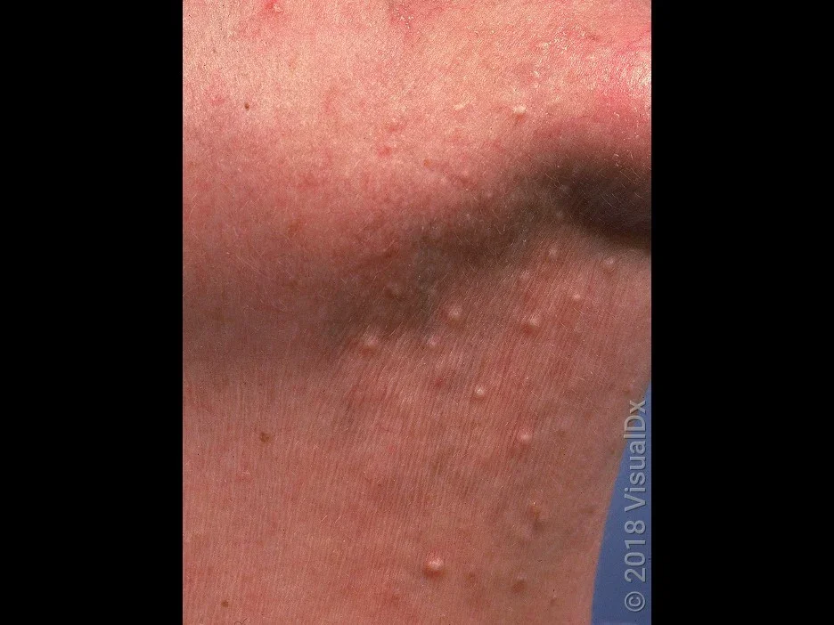 Close-up of milia on the chin and neck. 