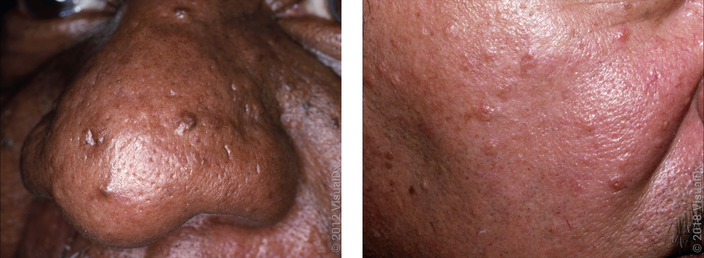 Left: Several small brown bumps on the nose of a Black man. Right: Many yellowish-pink small bumps on the cheek of a white man. 