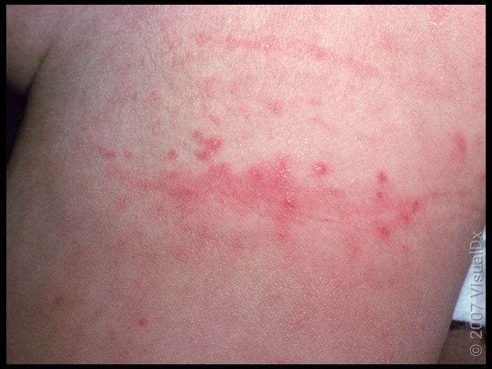 Close-up of the leg with red patches and bumps caused by diaper rash. 