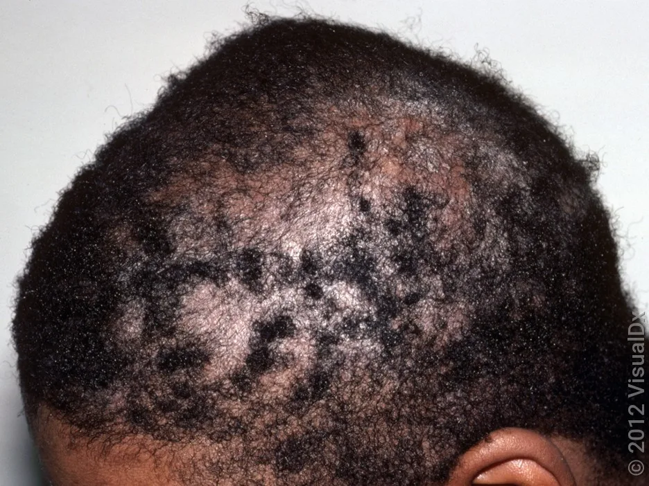 Close-up of scalp psoriasis with scaly patches and some hair loss.