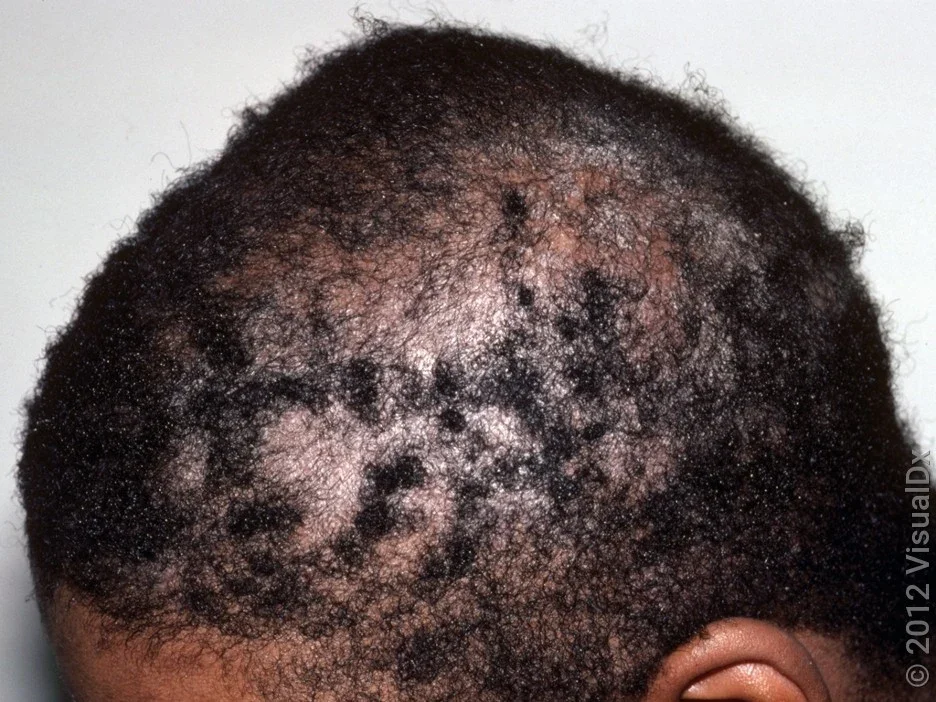 Close-up of scalp psoriasis with scaly patches and some hair loss. 