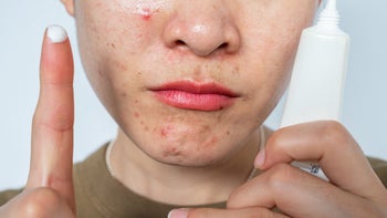 Acne: person with acne holding cream 1328606300
