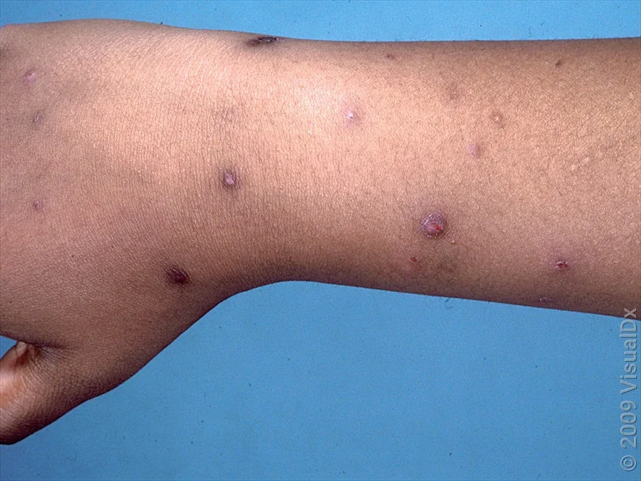 An arm with violet skin bumps caused by scabies. 