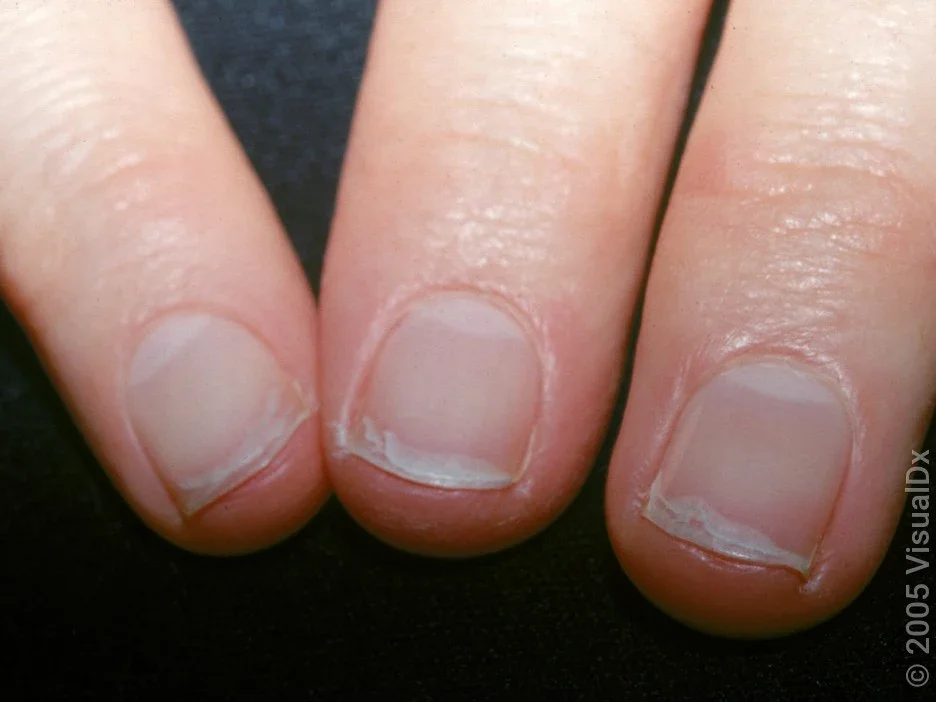 Peeling and splitting at the tips of the nails. 