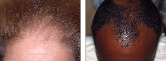 Left: Close-up of scalp with thinning hair at the front of the scalp in androgenic alopecia. Right: Close-up of a receding hairline in androgenic alopecia.