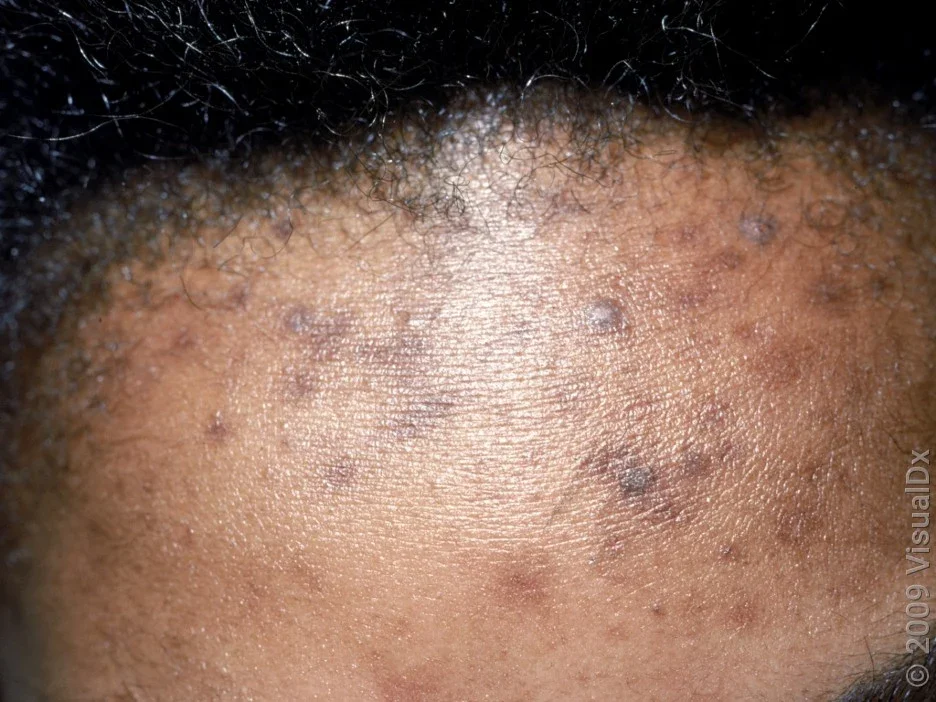 Hyperpigmentation on the face caused by acne. 