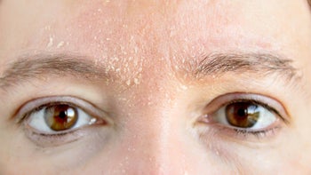 dry-skin: closeup forehead with dry skin 900018018