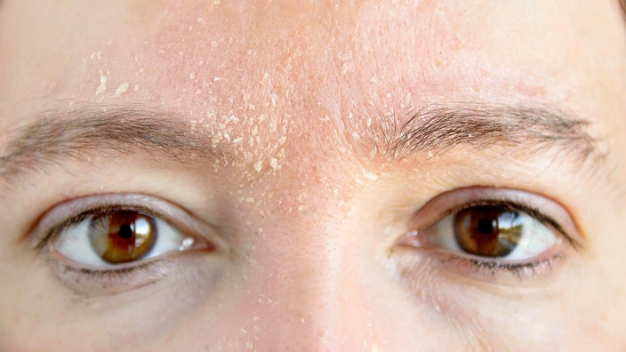 Close-up of a forehead with dry skin.