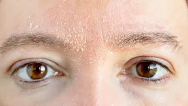 dry-skin: closeup forehead with dry skin 900018018
