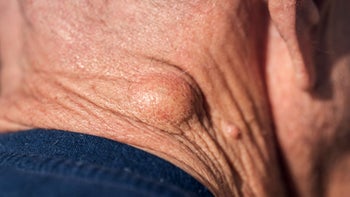 close up lipoma neck 1331886529