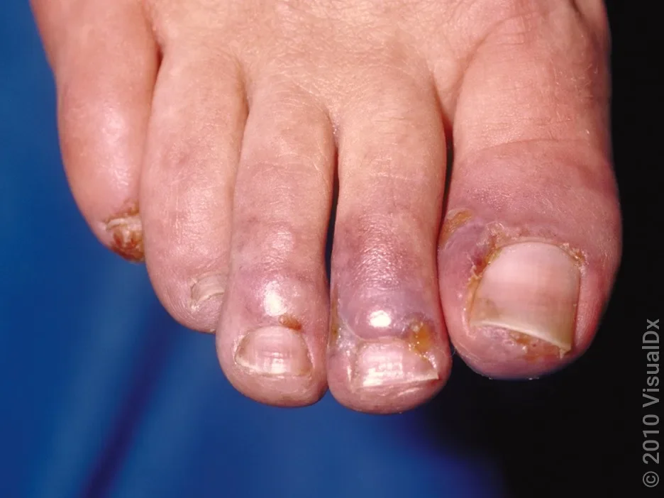 Close-up of chilblains on the toes in fair skin.