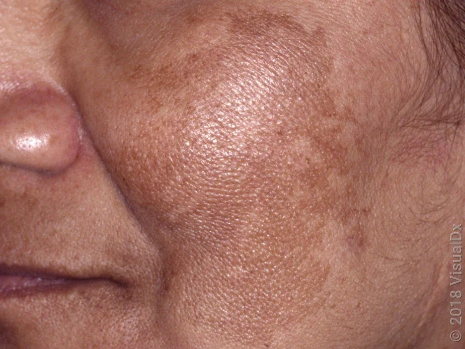 A close-up look at melasma on the cheek.