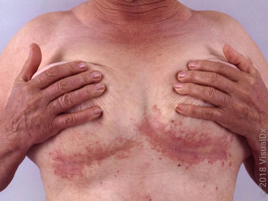 Close-up of the chest with pink patches under the breasts in inverse psoriasis. 