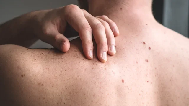 What to Know About Aldara Cream (Imiquimod) for Basal Cell Carcinoma