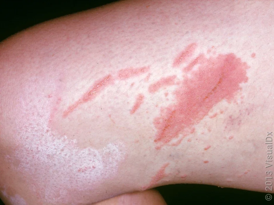 How Long Does a Poison Ivy Rash Take to Heal? - GoodRx