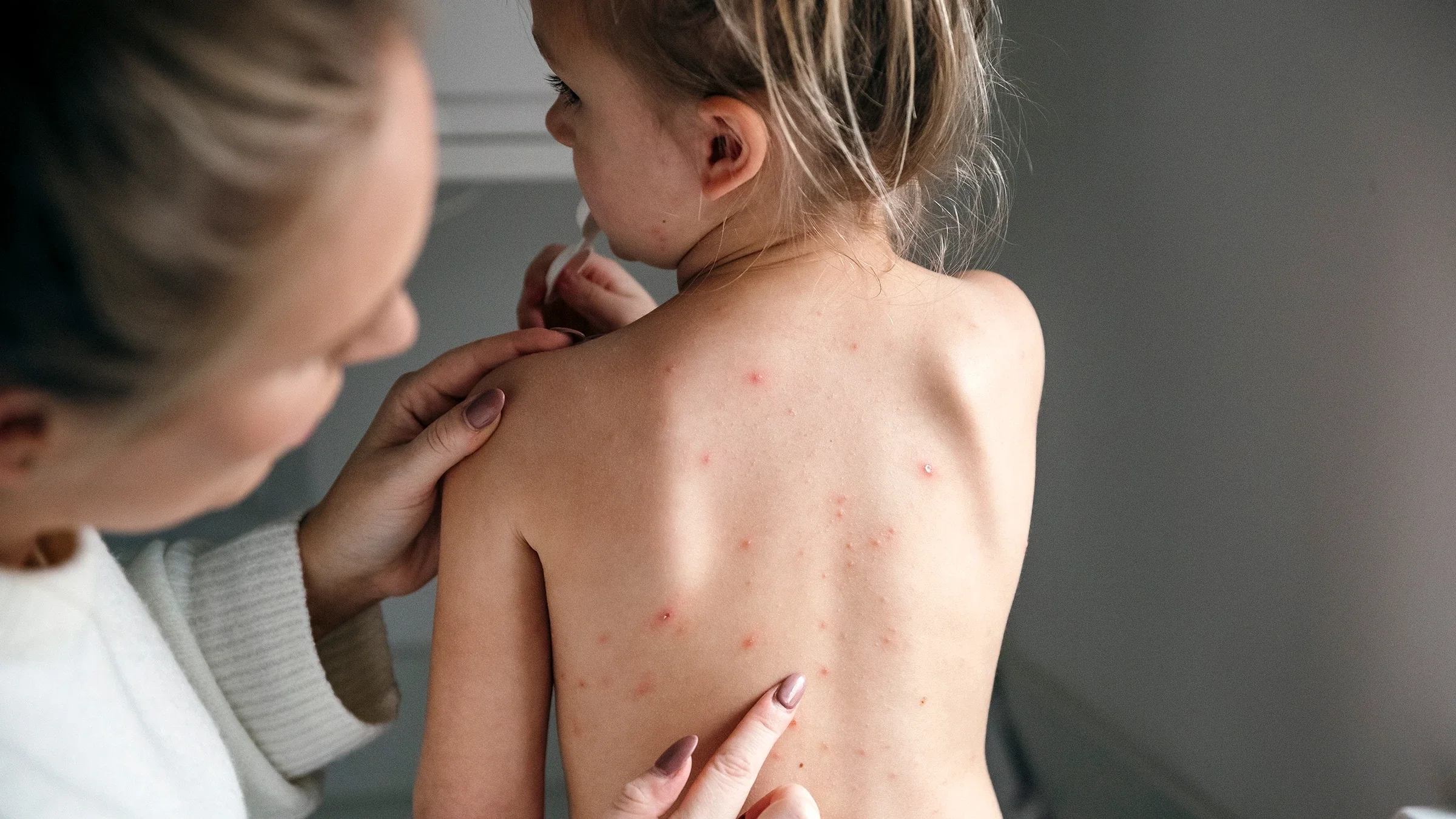 A woman examines her daughter’s back, which is covered in chickenpox bumps.