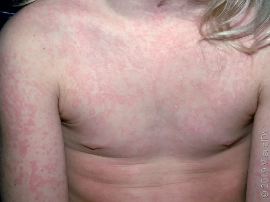 Fifth disease rash on the torso and arms. 