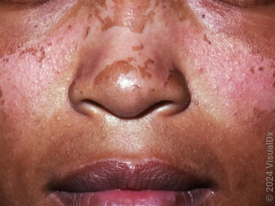 Peeling after a sunburn on the face.