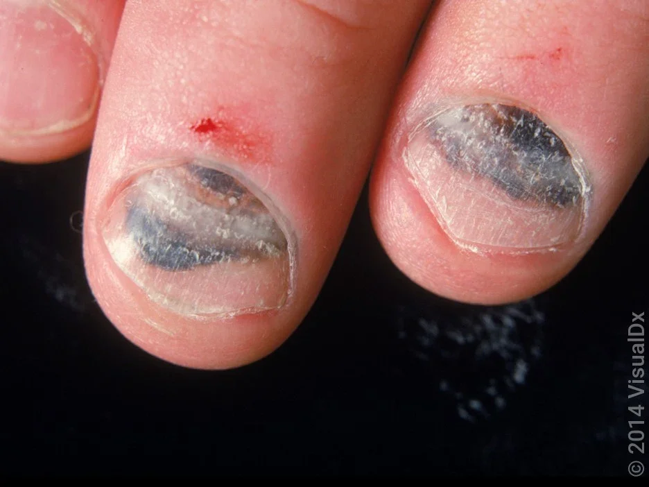 Close-up of a subungual hematoma on two nails.