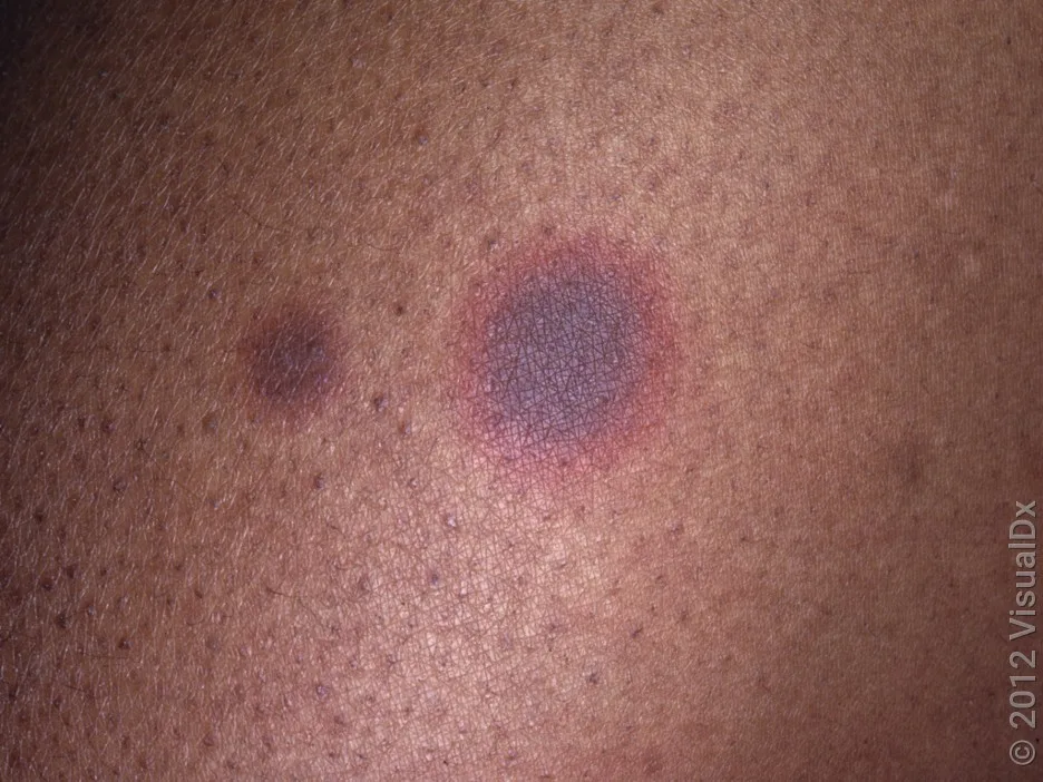 A typical fixed drug eruption.