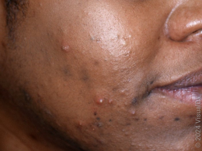 Brown and red bumps and dark marks on the cheek and chin in hormonal acne.
