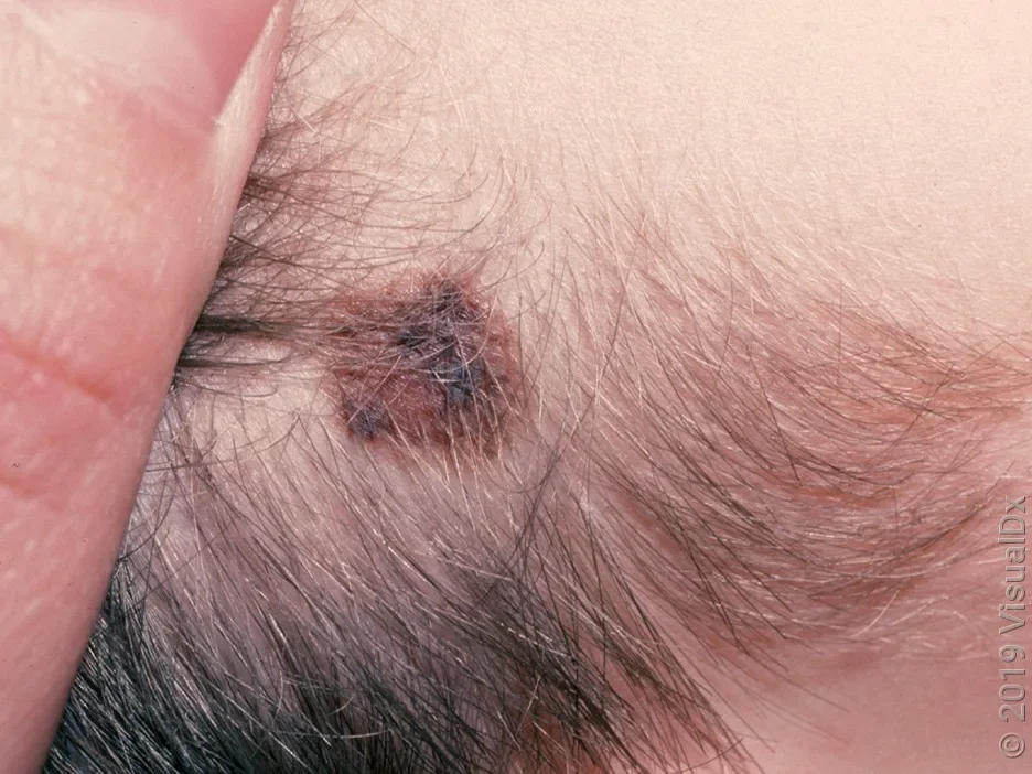 Close-up of a large atypical mole on the scalp. 