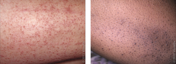 Left: Skin covered in tiny, pinpoint red bumps. Right: Skin covered in tiny, pinpoint brown bumps. 