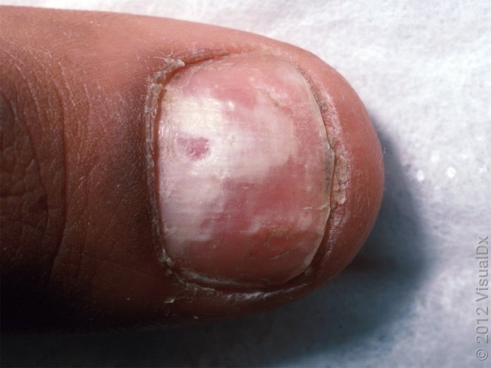Close-up of a nail with white discoloration and cracking.  
