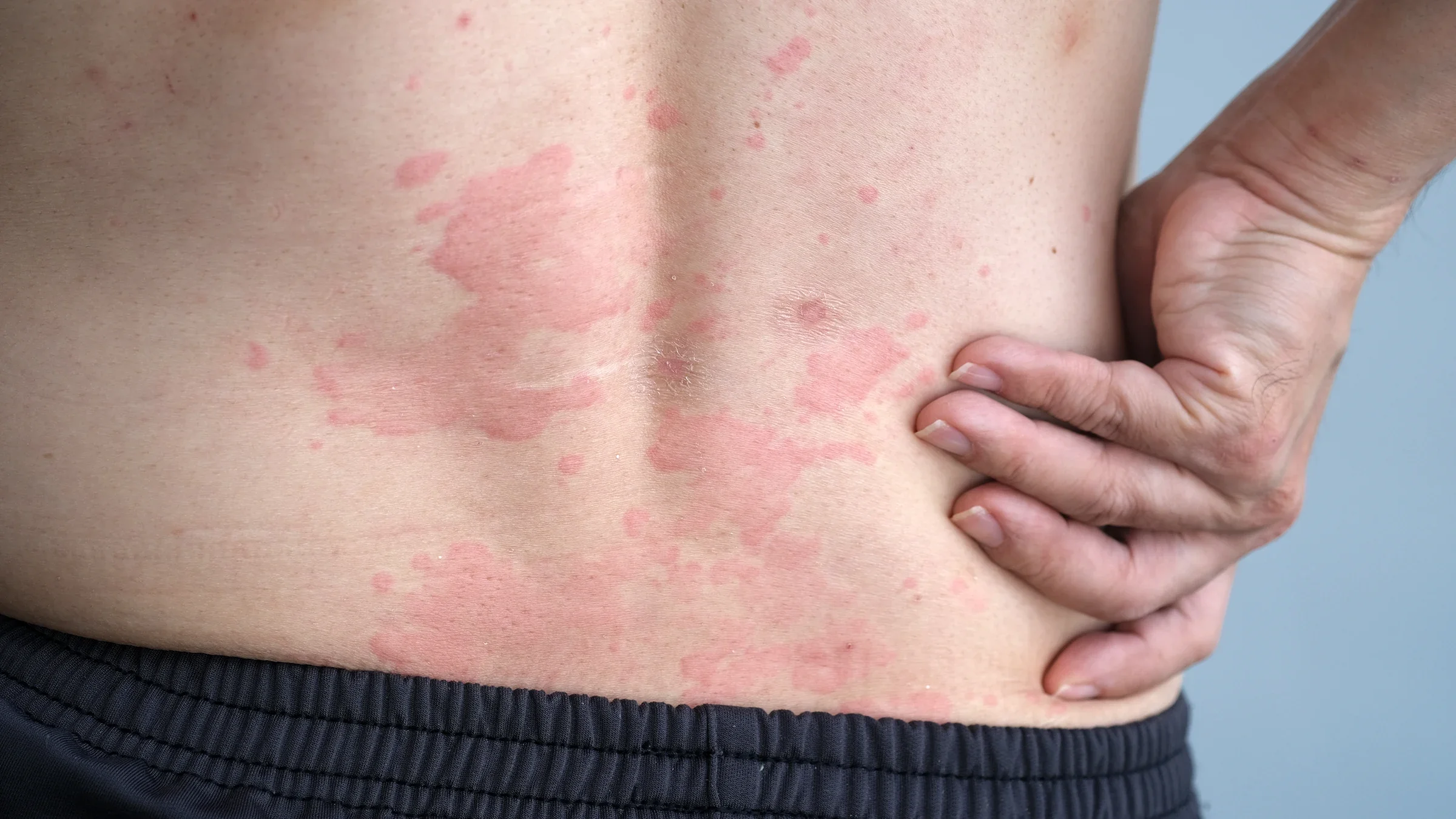 Close-up of skin hives on a person's back.
wisely/iStock via Getty Images Plus