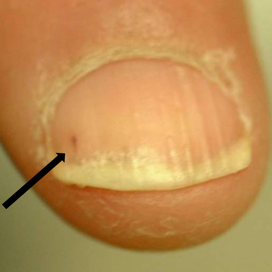 Psoriatic Arthritis Nail Symptoms: 6 Common Signs - GoodRx Psoriatic Arthritis Nail Symptoms: 6 Common Signs - GoodRx