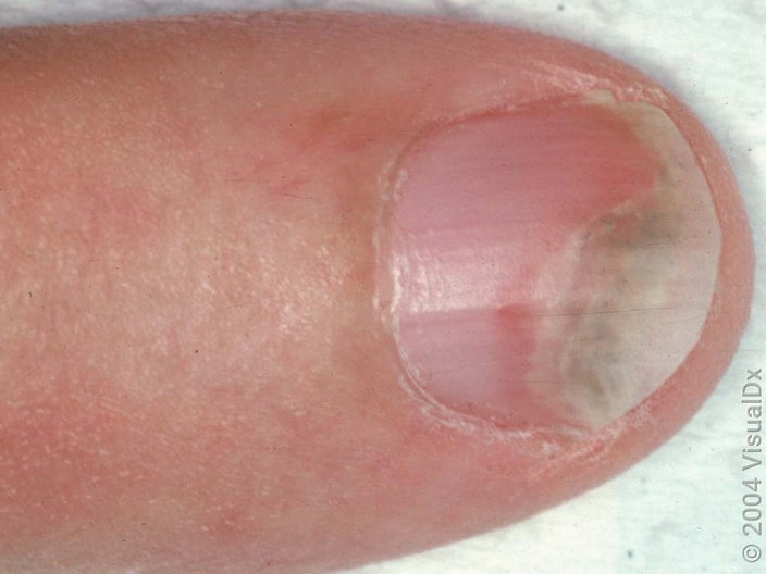 Close-up of a nail with a white tip (onycholysis from nail psoriasis). 