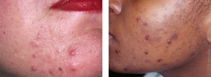 Different Types of Acne and Treatment With Pictures GoodRx