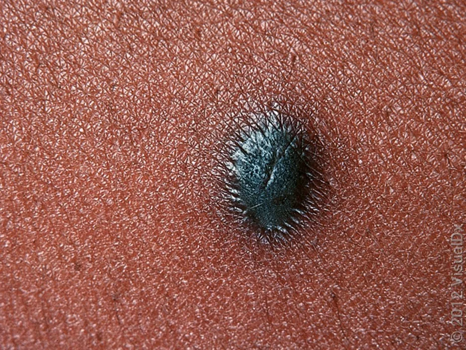 Dark dermatofibroma on a darker skin tone.