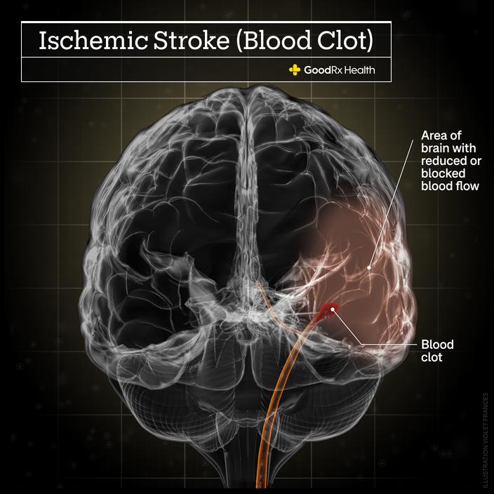 A 3D illustration of an ischemic stroke including area of brain with reduced or blocked blood flow and blood clot.