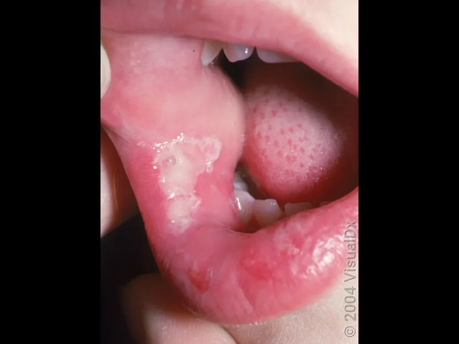 Close-up of a large canker sore inside the mouth.