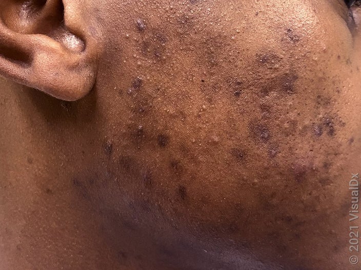 Close-up of a cheek with many brown patches (acne marks) mixed with acne.
