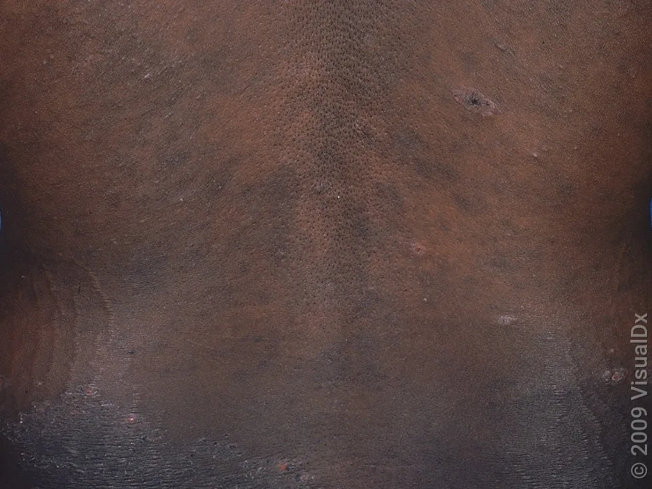 Early stages of the SJS rash on a person’s back. 
