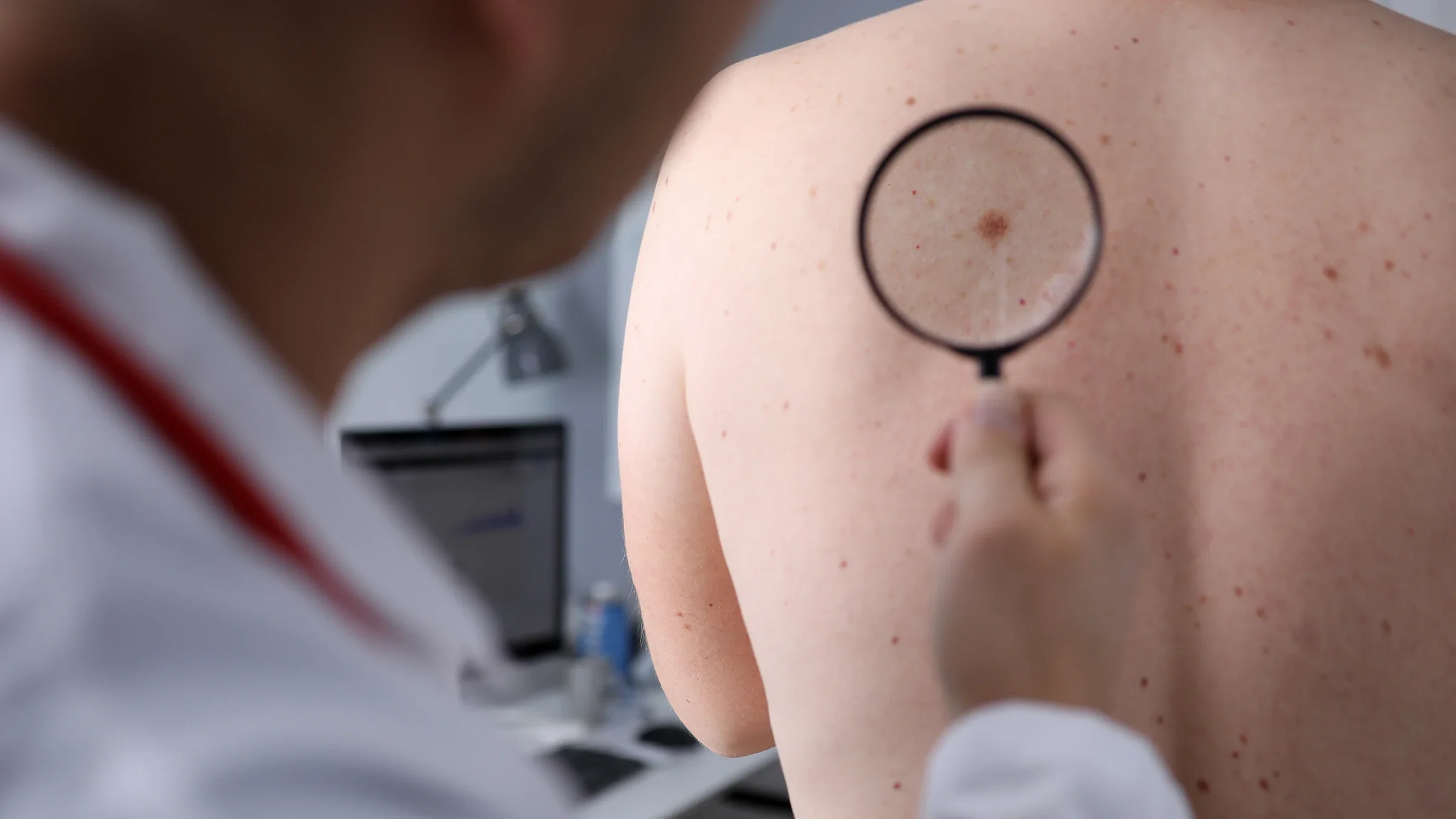 A provider is examining a person’s mole with a magnifying glass. The mole is on their back.
Ivan-balvan/iStock via Getty Images