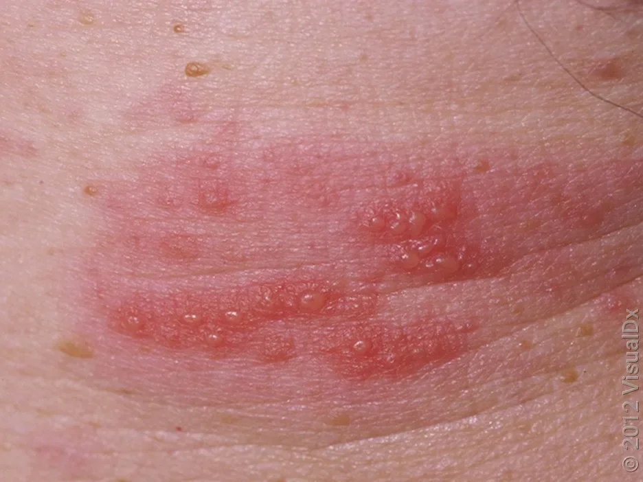 Grouped blisters caused by shingles.