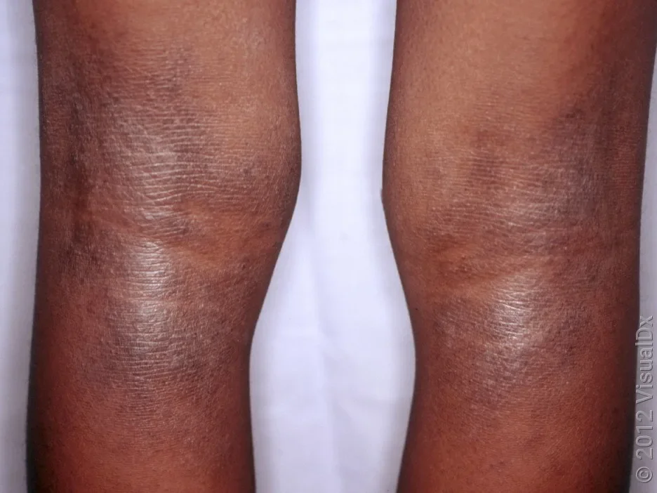 Close-up of eczema behind the knees in darker skin tones.