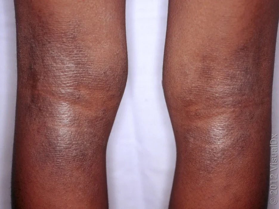 Close-up of eczema behind the knees in darker skin tones.