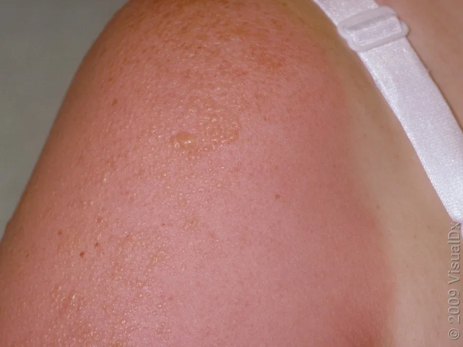 Close-up of sunburn blisters on the shoulder.