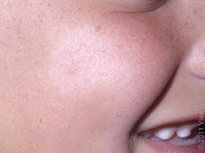 Close-up of the cheek with a faint light patch. 